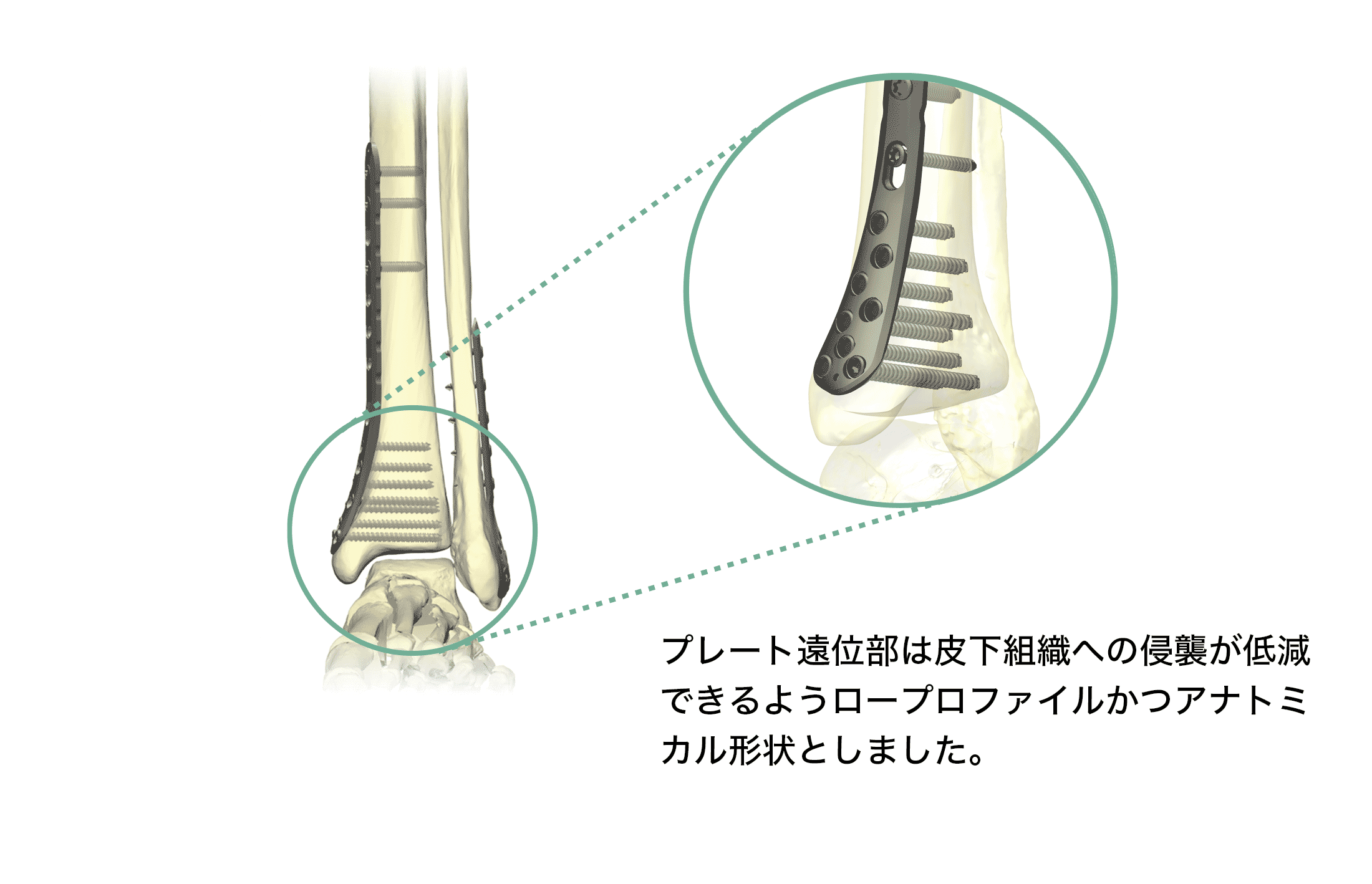 HAI脛骨遠位端ロッキングプレートシステム