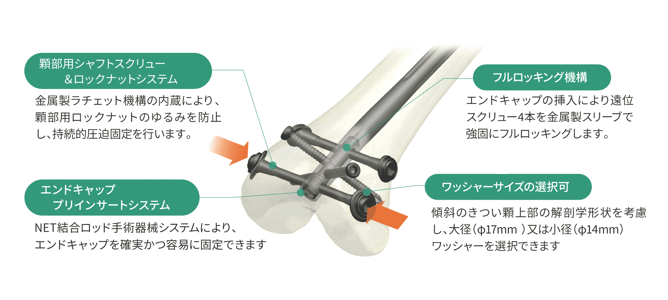 HAI大腿骨逆行性髄内釘システム