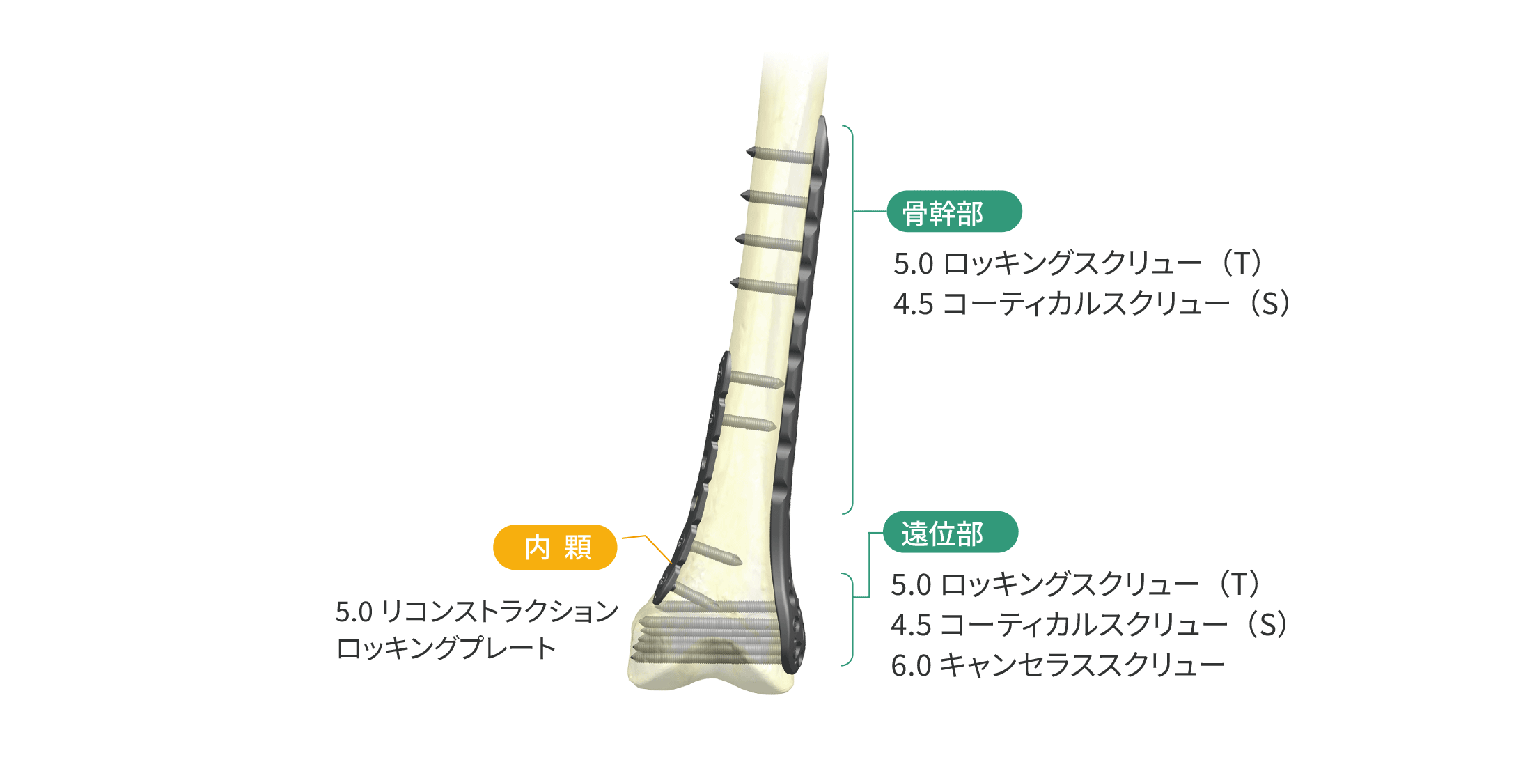 HAI大腿骨遠位端ロッキングプレートシステム