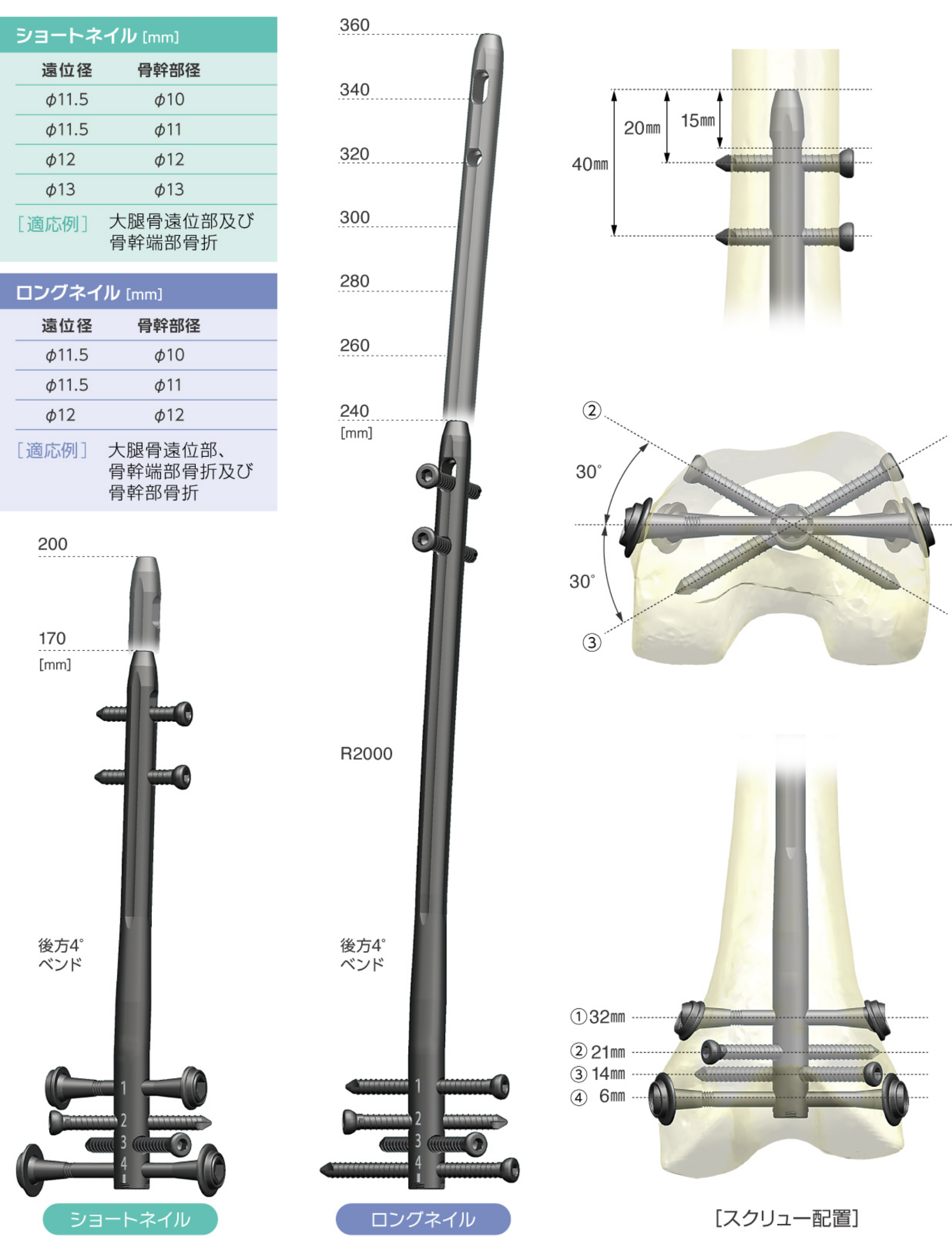Implant Overview