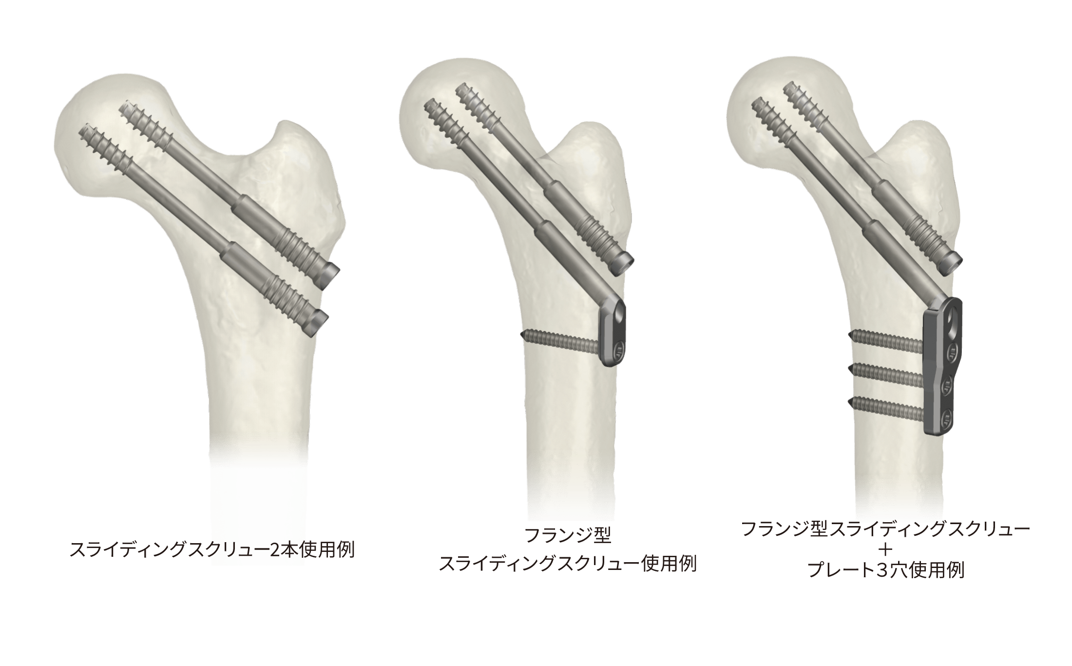 TLSスクリューシステム