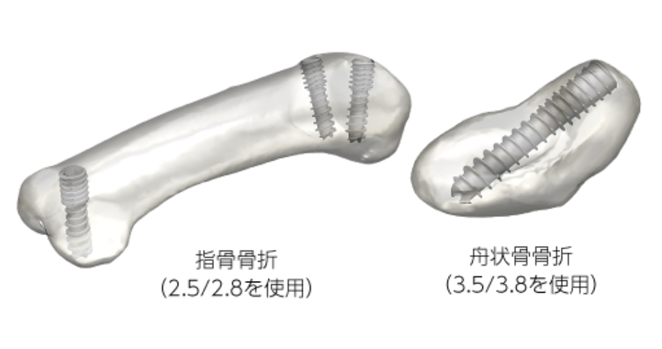 SCS Self Compression Screw