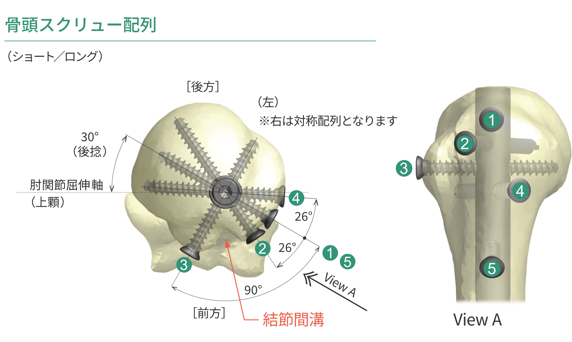 HAI上腕ネイルシステム