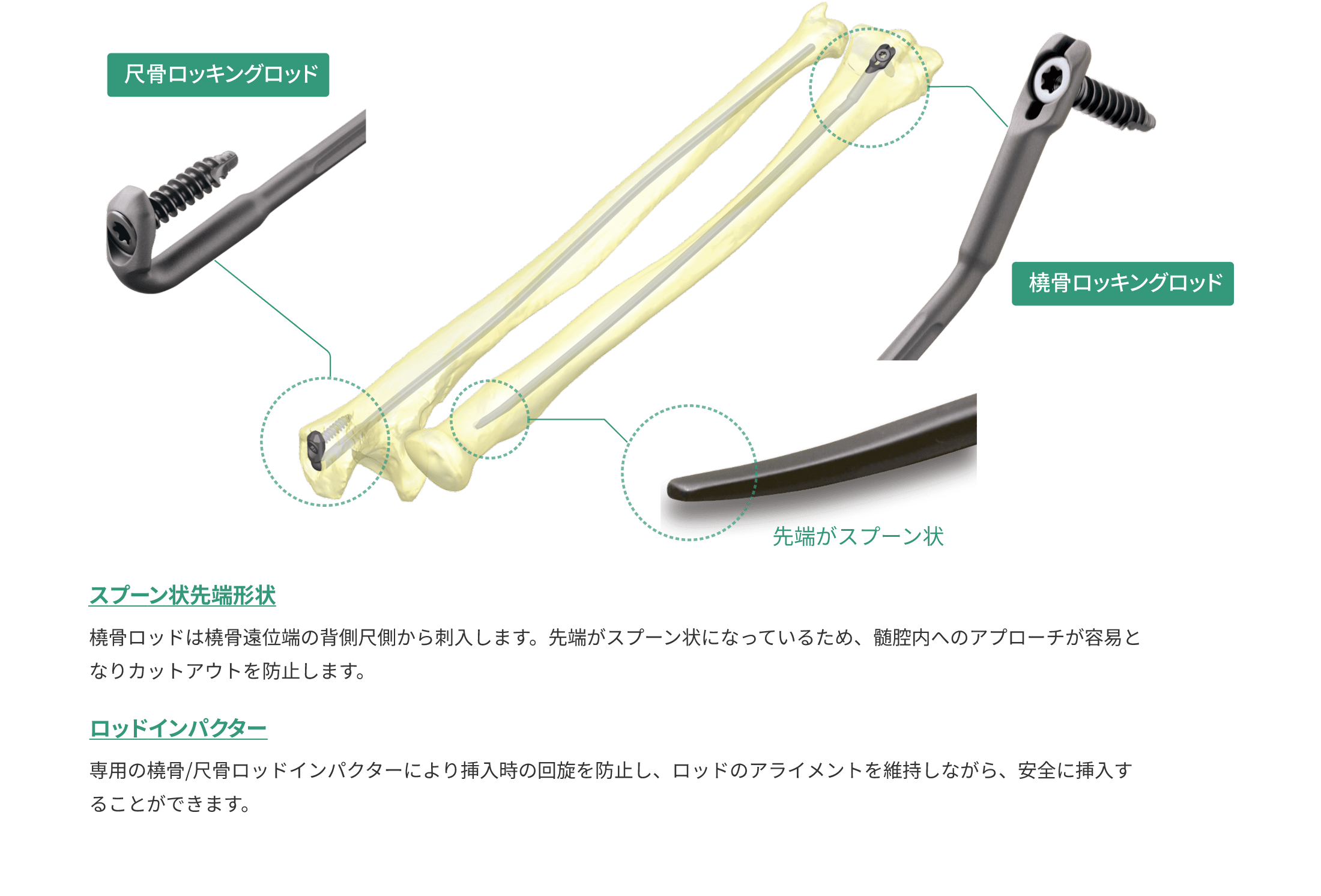 HAI橈・尺骨ロッキングロッド