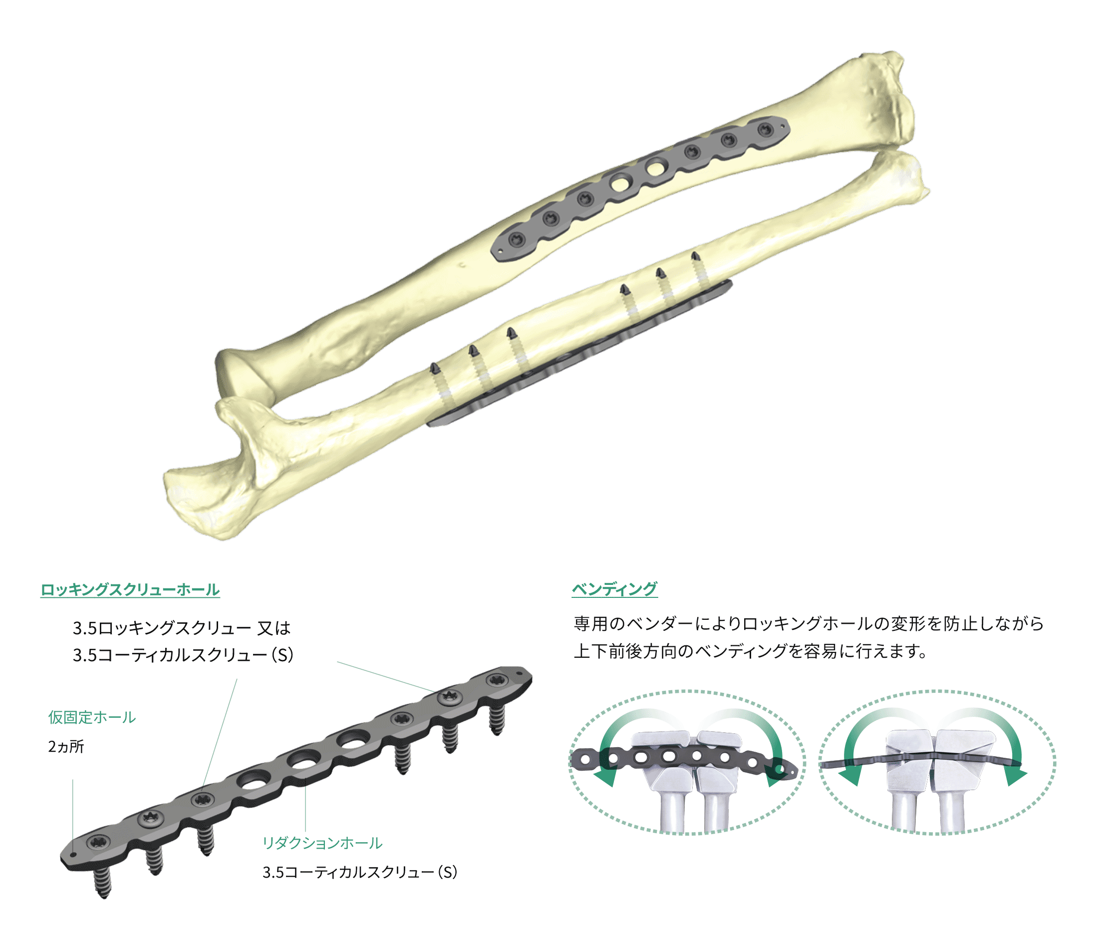 HAIリコンストラクションロッキングプレート