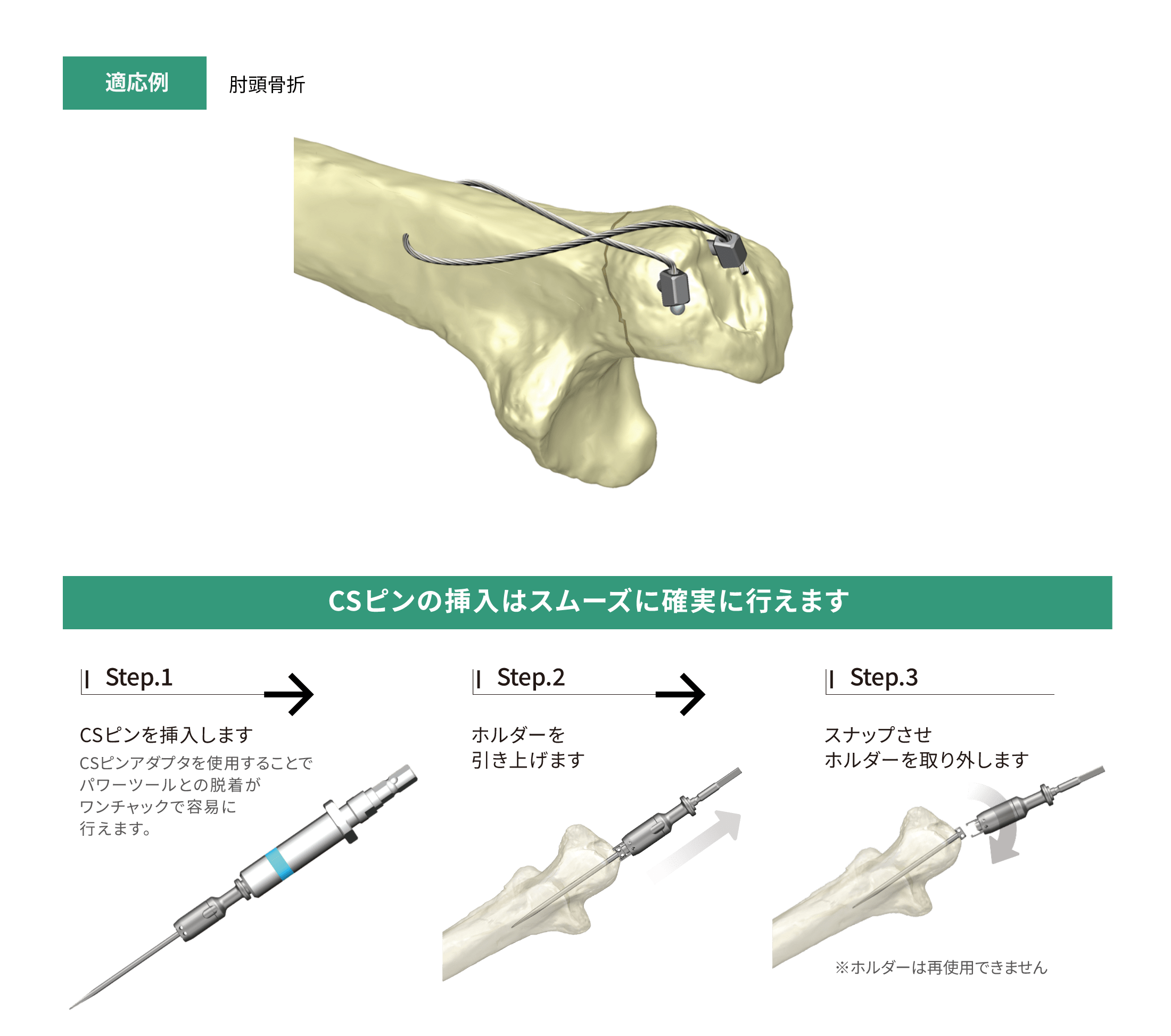 CSPワイヤリングシステム［SUS/Ti］