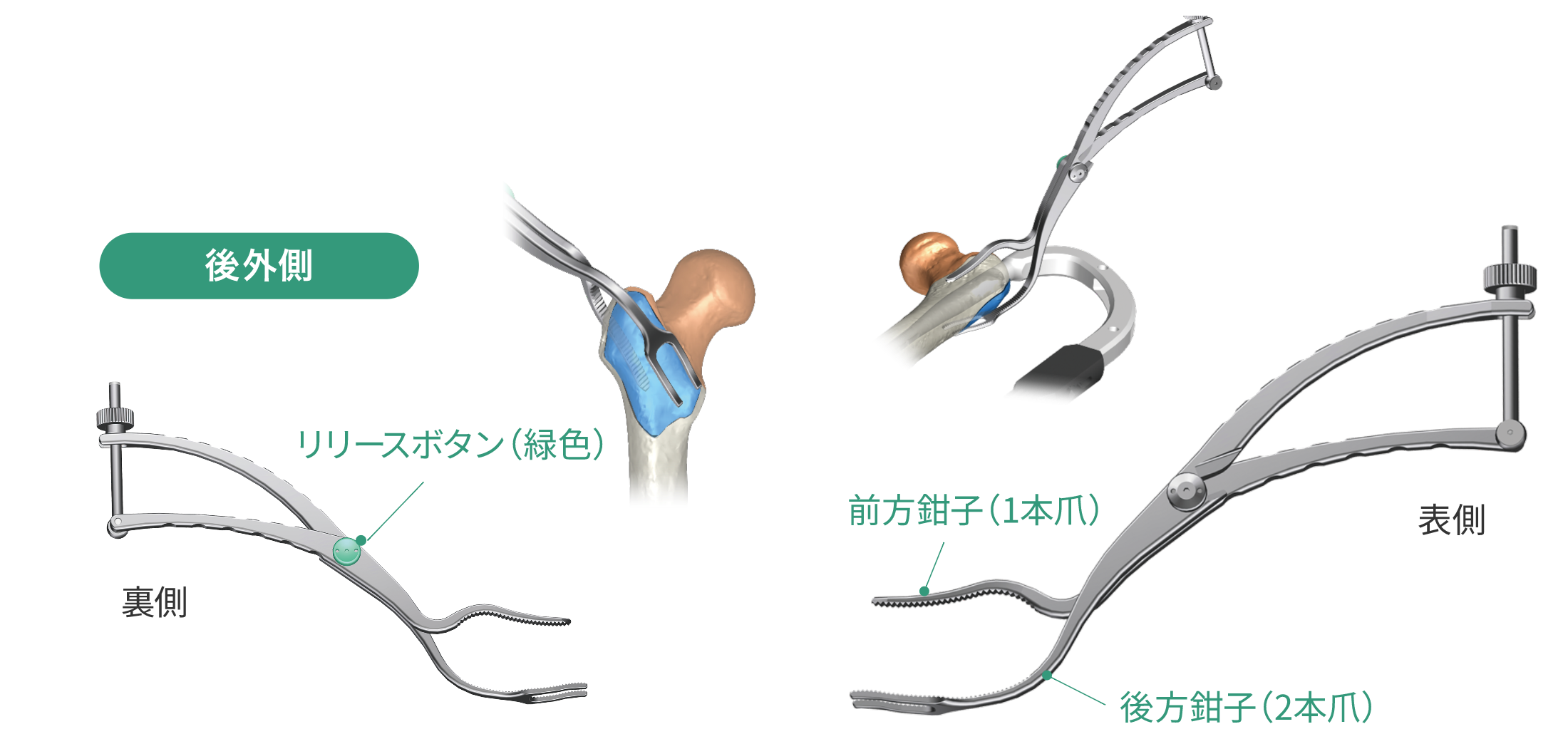 大腿骨転子部骨把持鉗子2