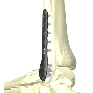 HAI腓骨遠位端外側ロッキングプレートシステム