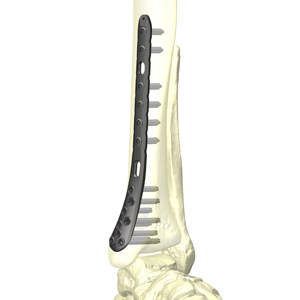 HAI脛骨遠位端ロッキングプレートシステム