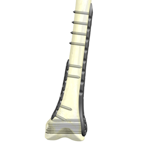 HAI大腿骨遠位端ロッキングプレートシステム