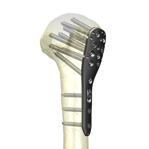 HAI上腕骨近位端ロッキングプレートシステム